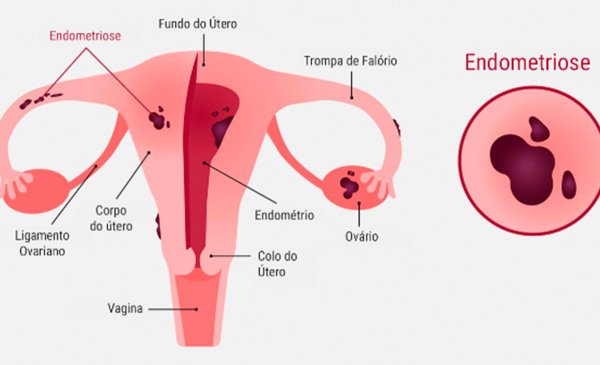 Tratamento para Endometriose